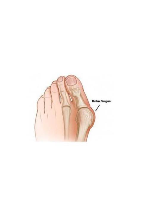 Case Hallux Valgus Gece Ateli 1 Adet Sağ + Sol