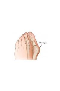 Case Hallux Valgus Gece Ateli 1 Adet Sağ + Sol